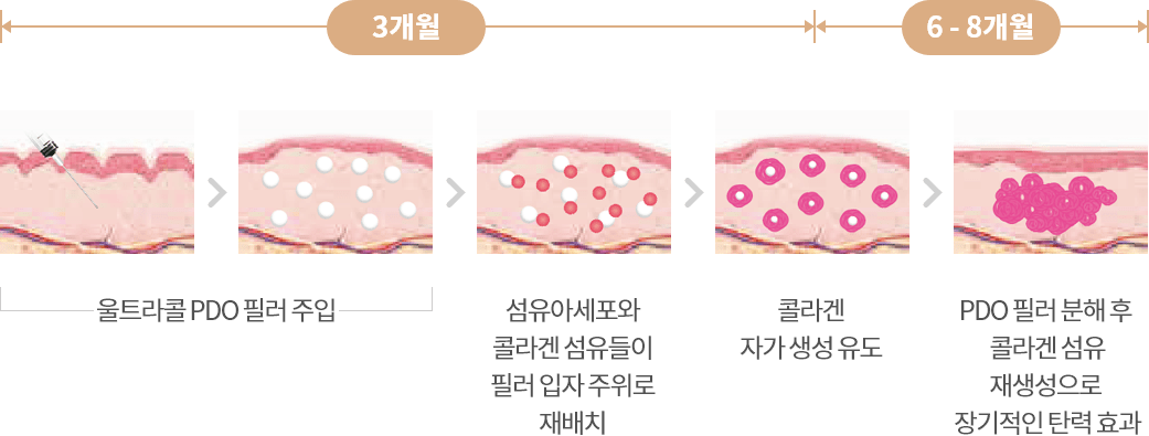 3개월, 6-8개월, 울트라콜 PDO 필러 주입, 섬유아세포와 콜라겐 섬유들이 필러 입자 주위로 재배치, 콜라겐 자가 생성 유도, PDO 필러 분해 후 콜라겐 섬유 재생성으로 장기적인 탄력 효과