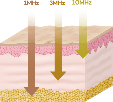 1MHz 3MHz 10MHz