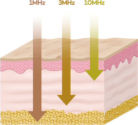 1MHz 3MHz 10MHz